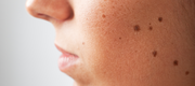 Understanding Melanoma: The Importance of Early Detection & Prevention