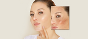 A Guide to Hyperpigmentation & Skincare Solutions