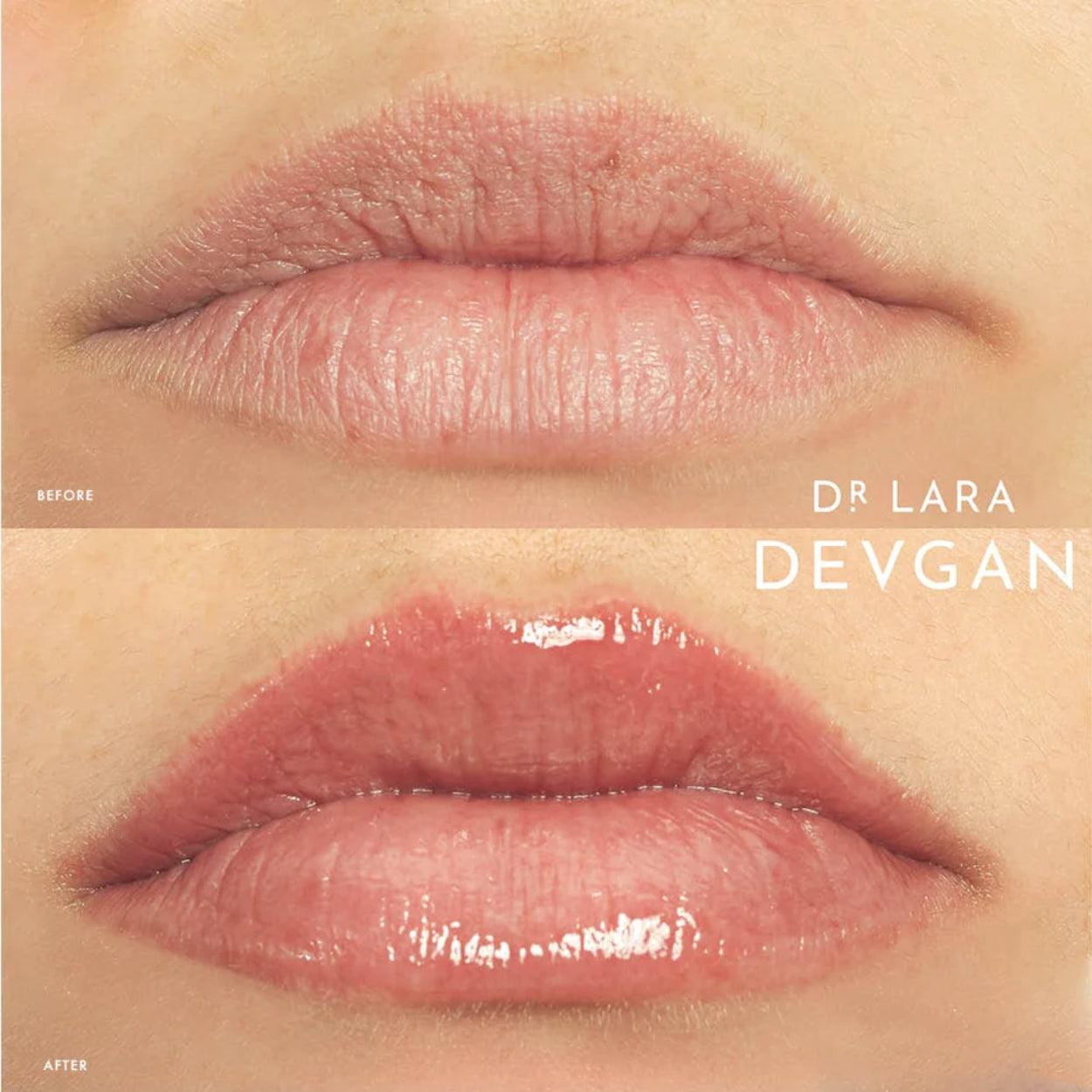 Platinum Lip Plump model Image