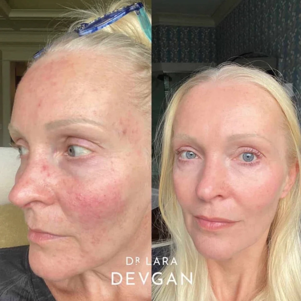 Retinal Bakuchiol Serum Model Image