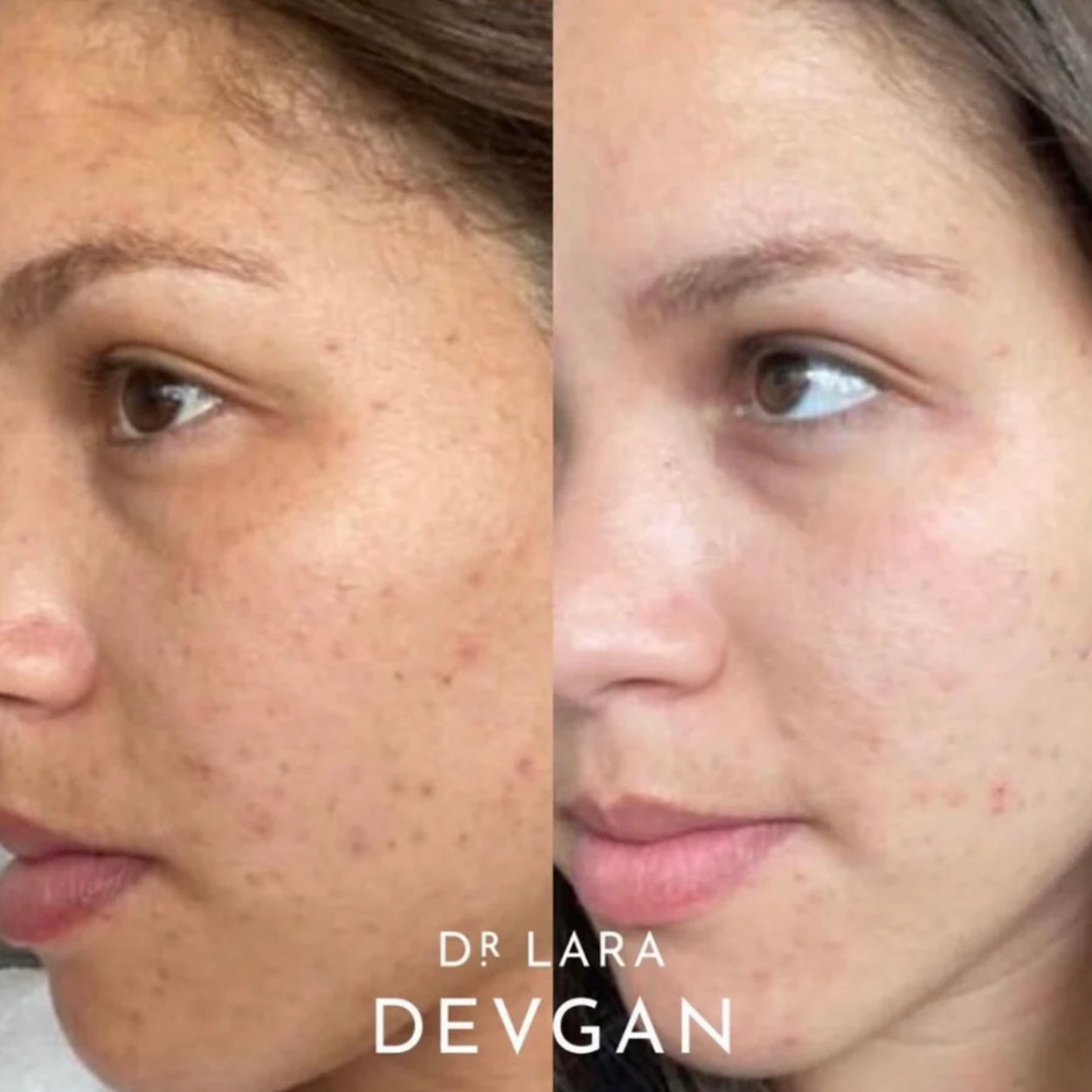 Retinal Bakuchiol Serum Model Image 1