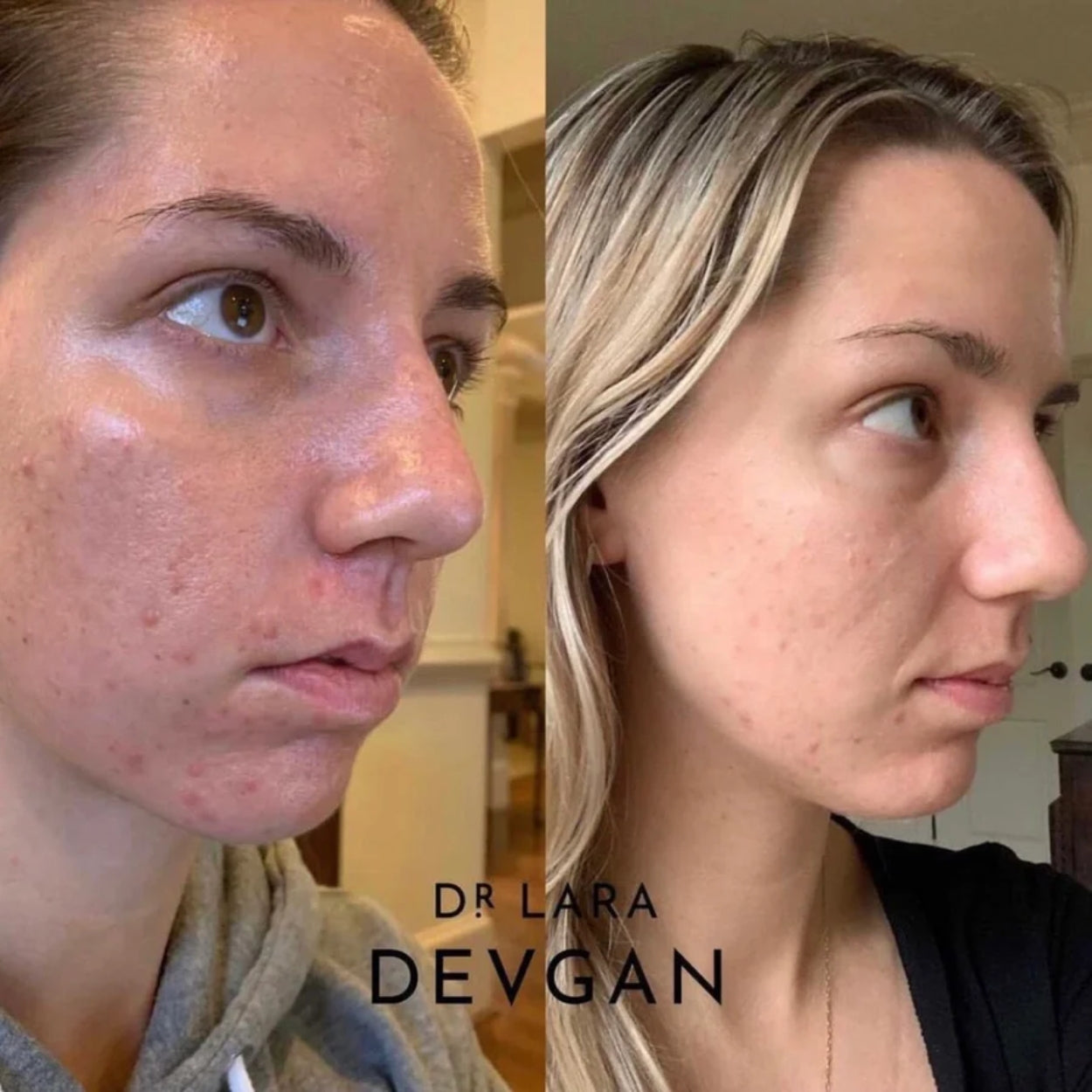 Retinal Bakuchiol Serum Model Image 5