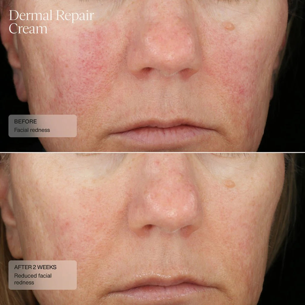 Sente Dermal Repair Cream Redness