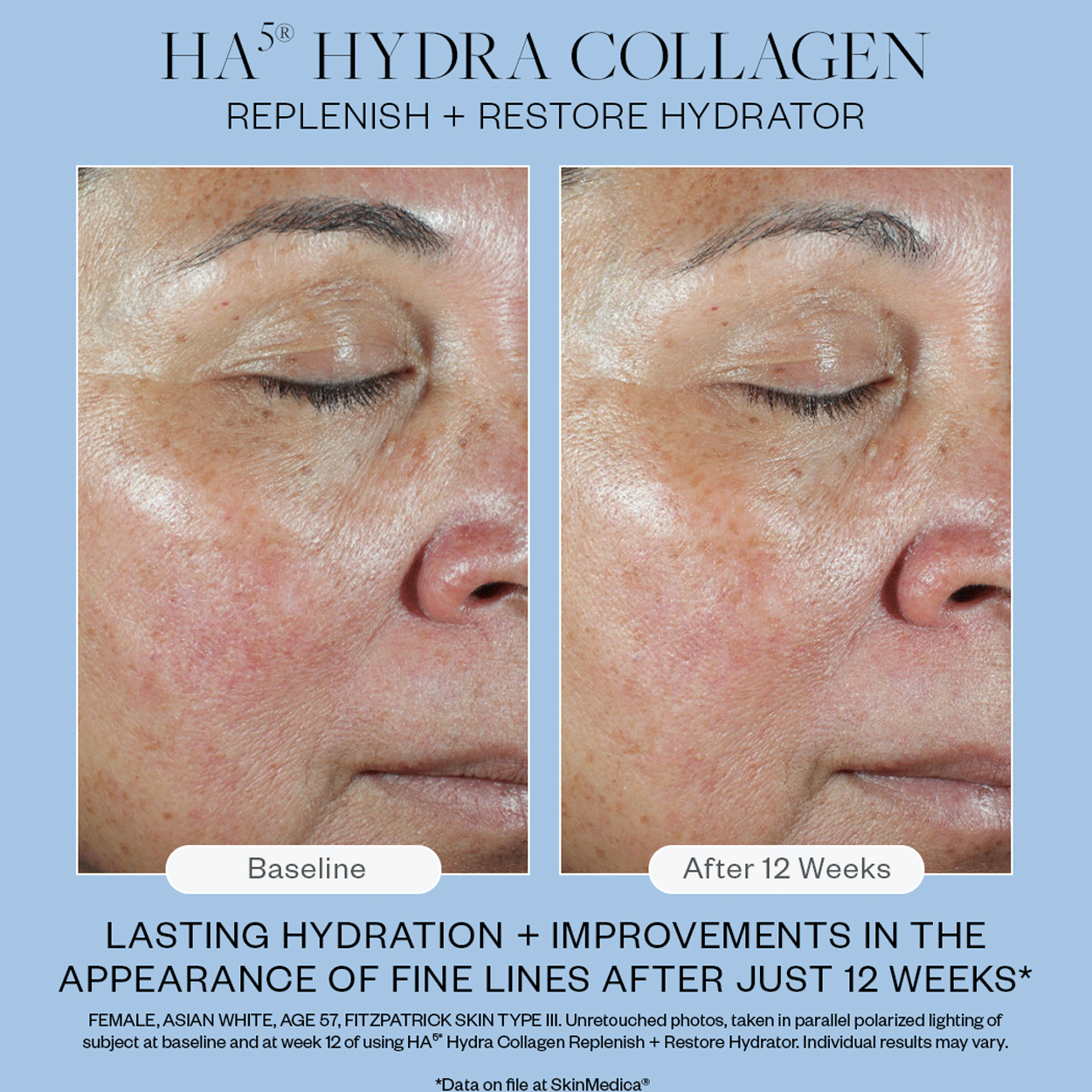 SkinMedica HA5 Hydra Collagen Replenish + Restore Hydrator Before After
