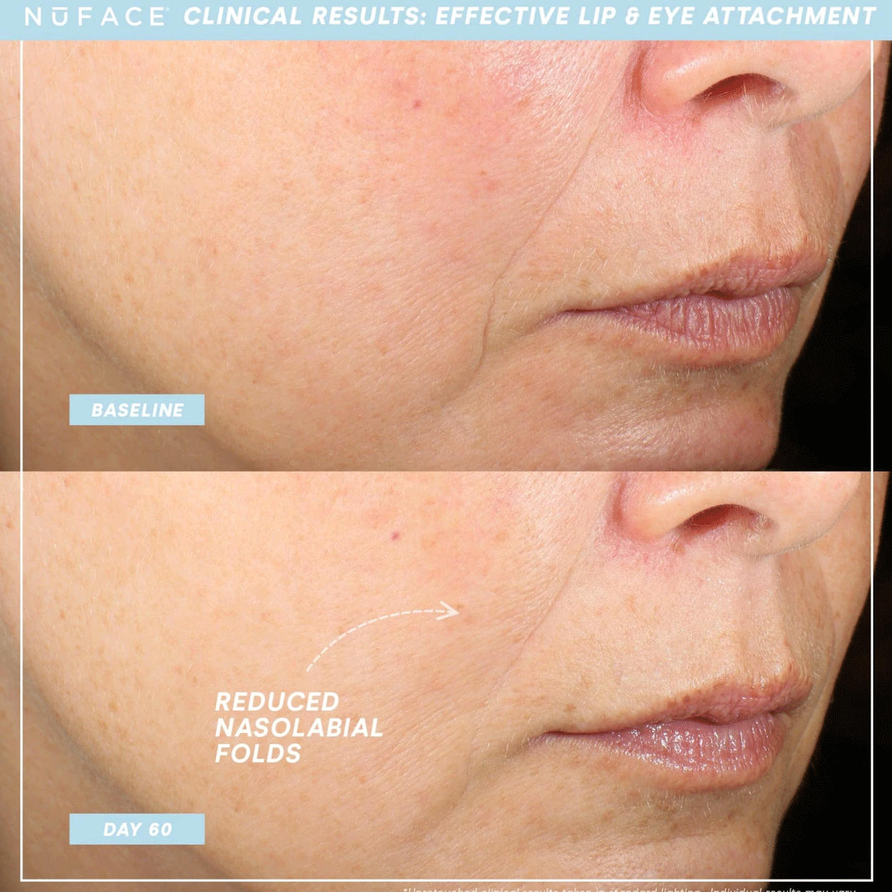 Trinity ELE Attachment (Effective Lip and Eye) Image 2
