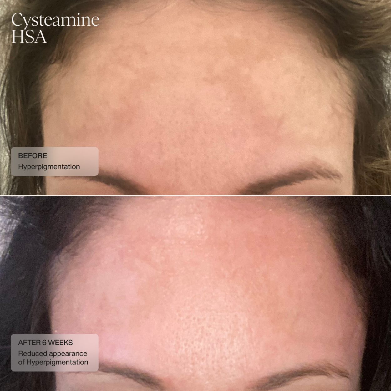 Cysteamine HSA Pigment Corrector