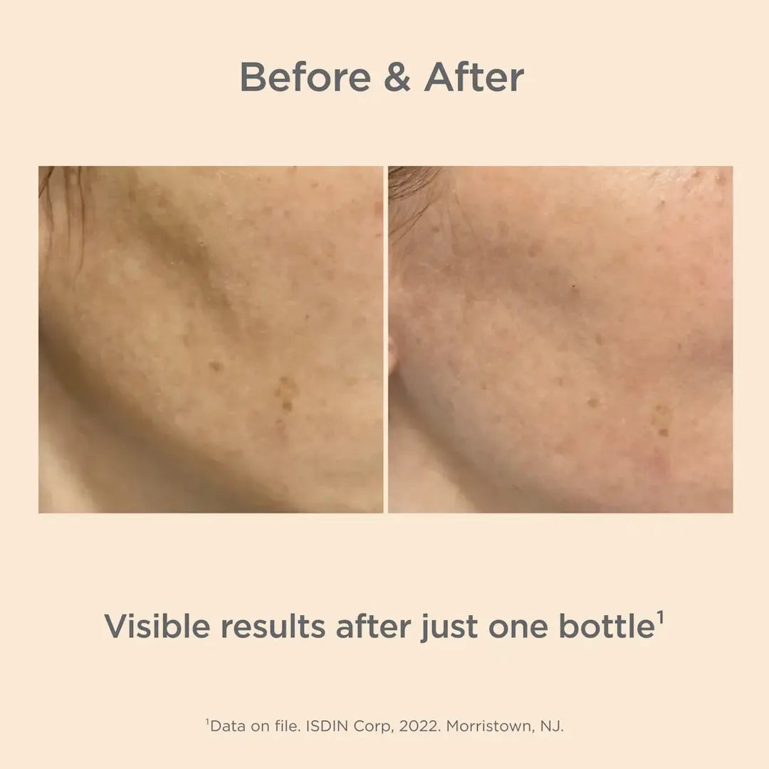 ISDINCEUTICS Melaclear Advanced before After Image