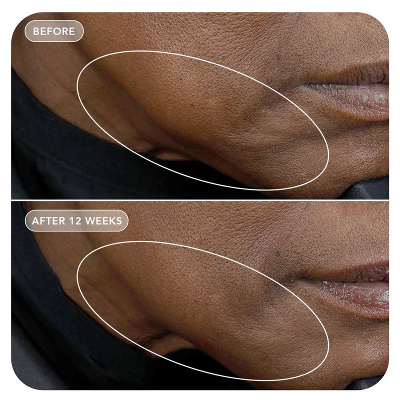 VOL.U.LIFT™ GLP-1 4D Skin Rebound Complex Model Image 4